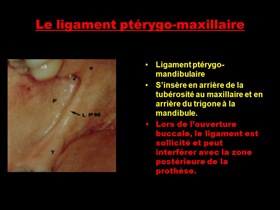 Le ligament ptérygo-maxillaire