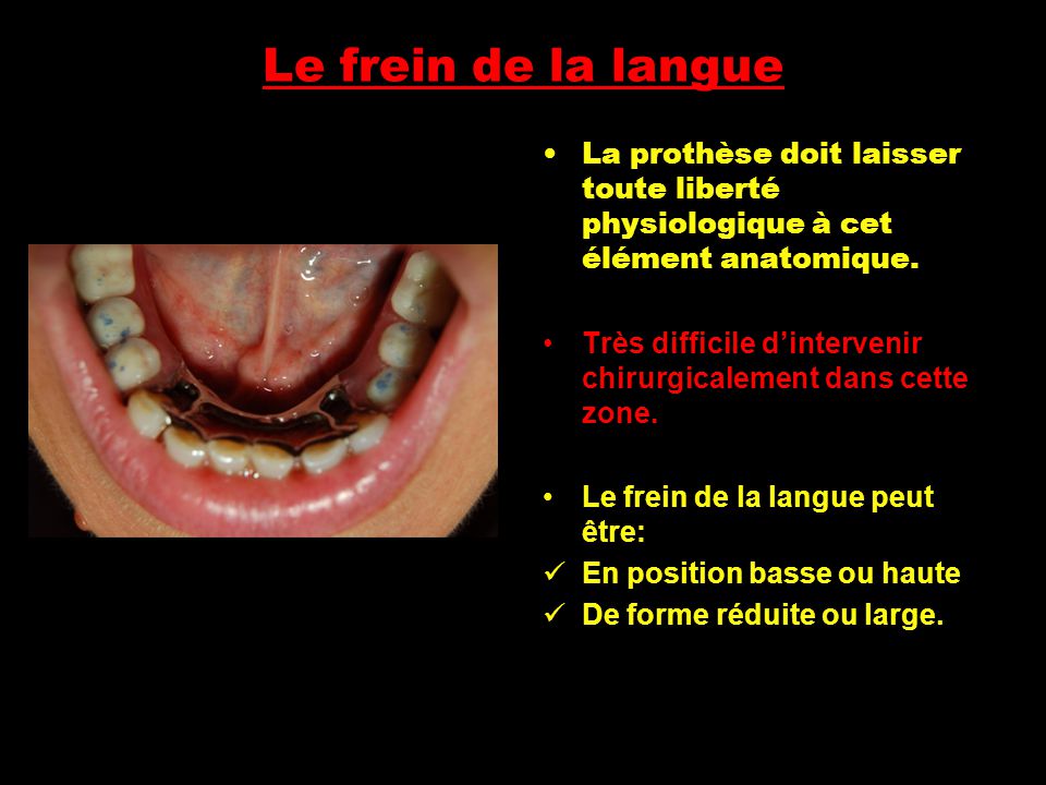Le frein de la langue La prothèse doit laisser toute liberté physiologique à cet élément anatomique.