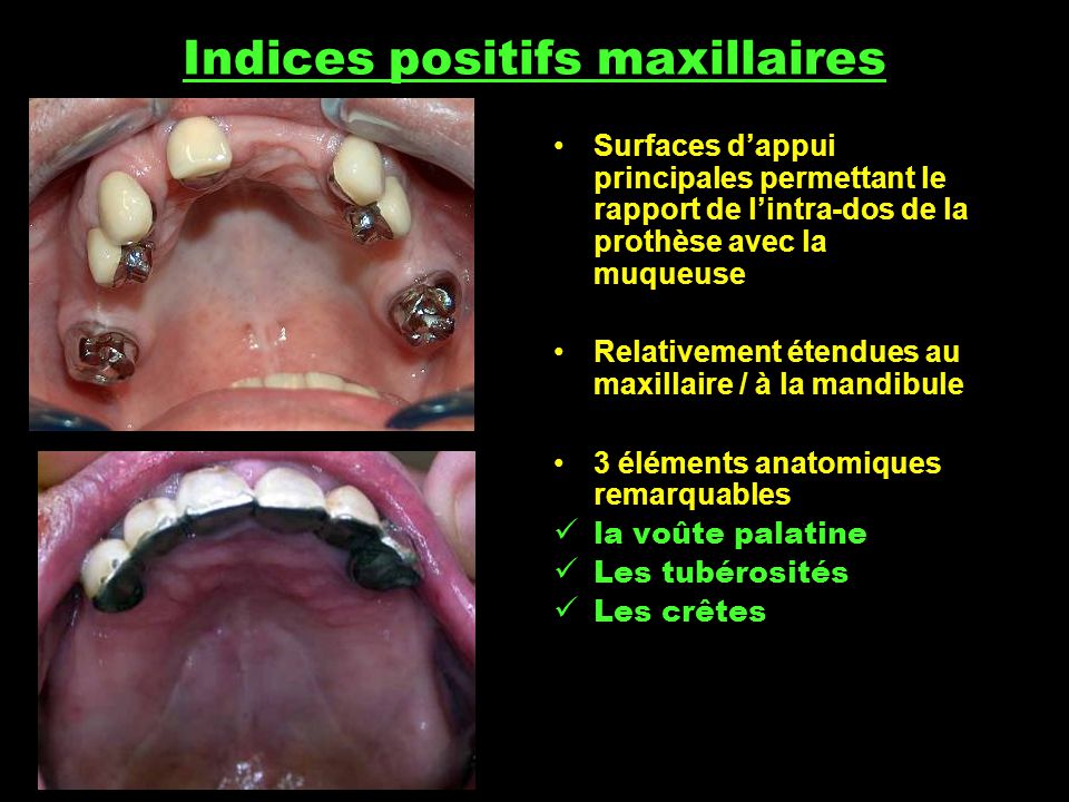 Indices positifs maxillaires