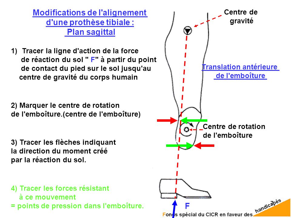 Modifications de l alignement d une prothèse tibiale : Plan sagittal F