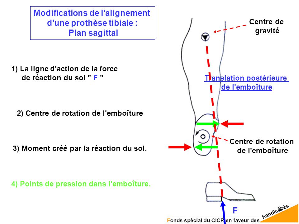 Modifications de l alignement d une prothèse tibiale : Plan sagittal F