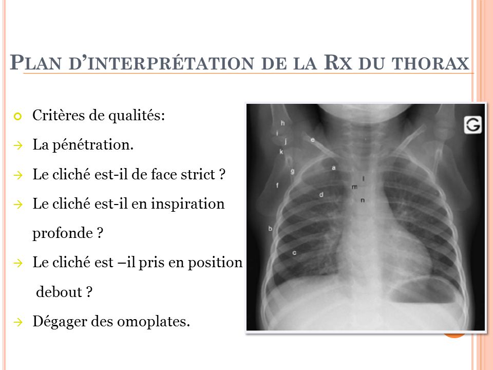 Plan d’interprétation de la Rx du thorax