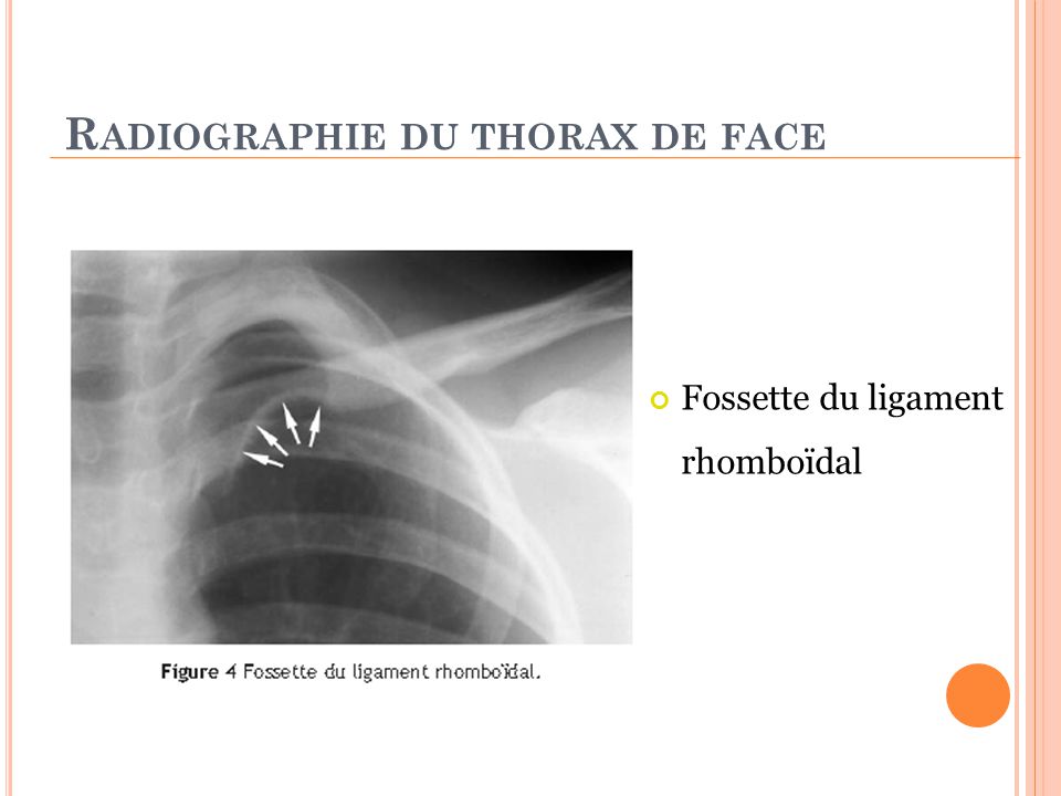 Radiographie du thorax de face