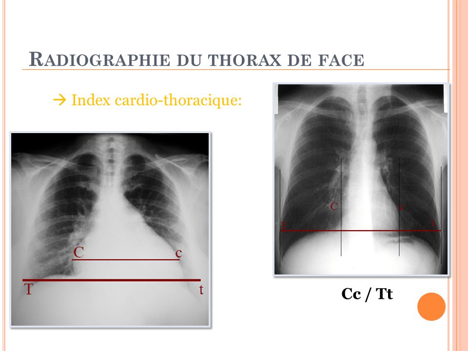 Radiographie du thorax de face