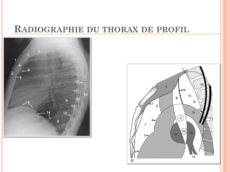 Radiographie du thorax de profil