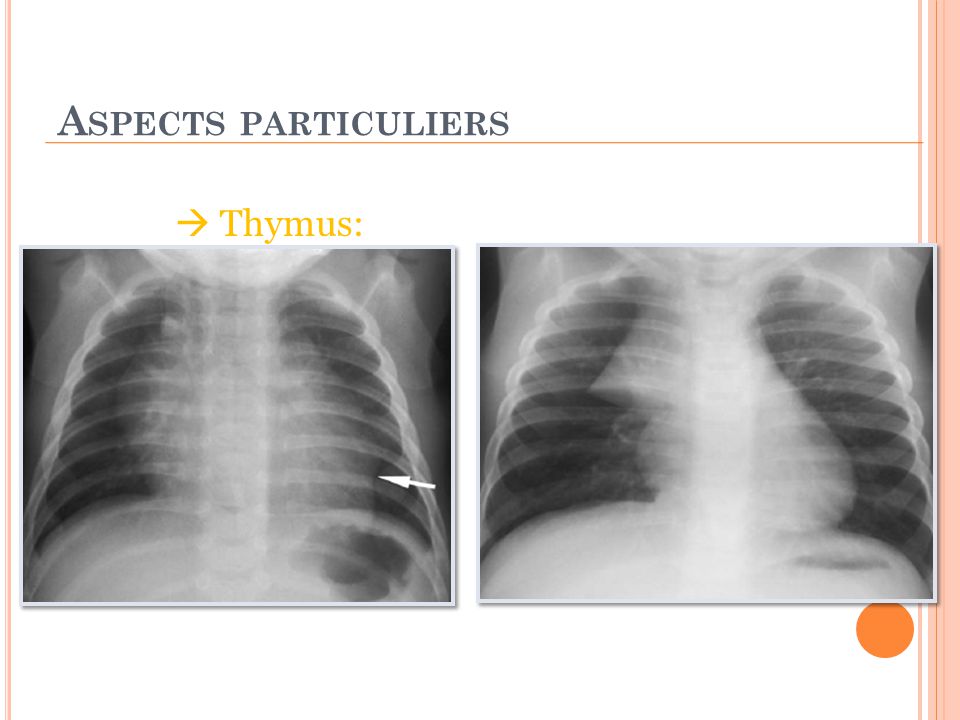Aspects particuliers  Thymus: Signe du raccordement