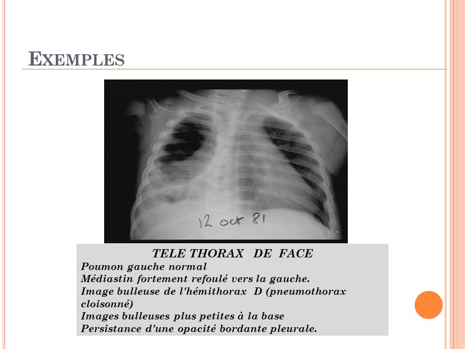 Exemples TELE THORAX DE FACE Poumon gauche normal