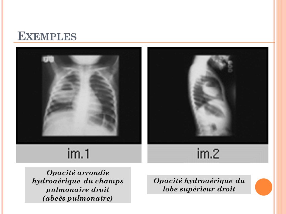 Exemples Opacité arrondie hydroaérique du champs pulmonaire droit