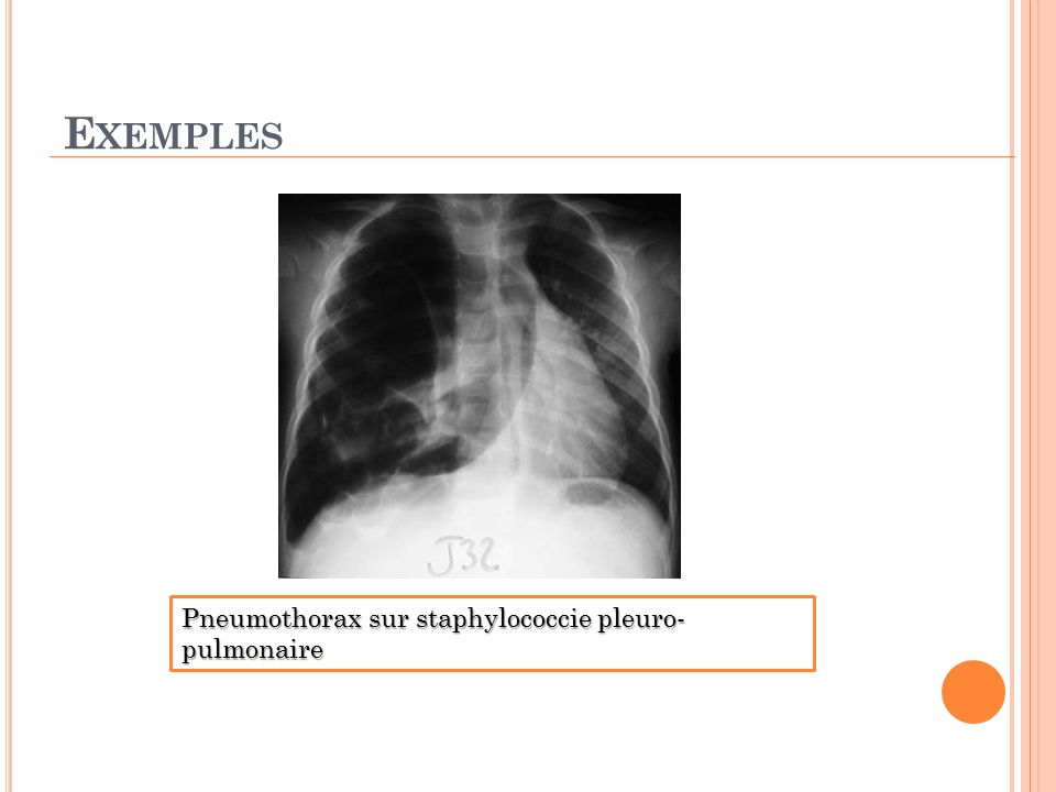Exemples Pneumothorax sur staphylococcie pleuro-pulmonaire