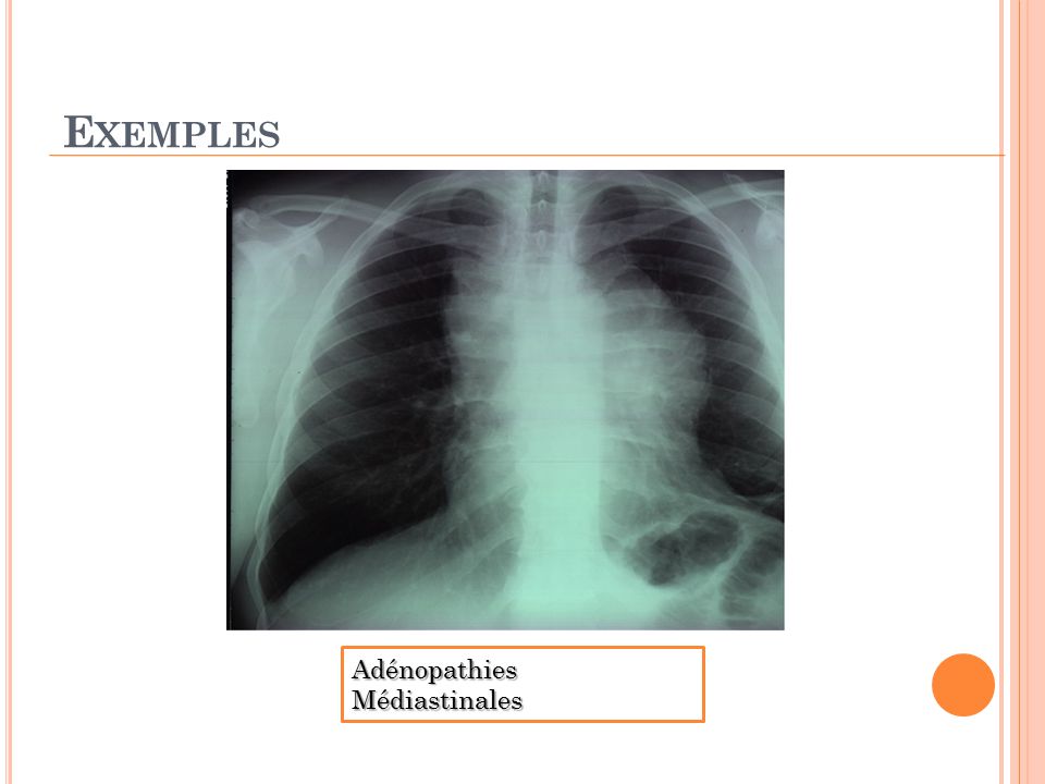 Exemples Adénopathies Médiastinales