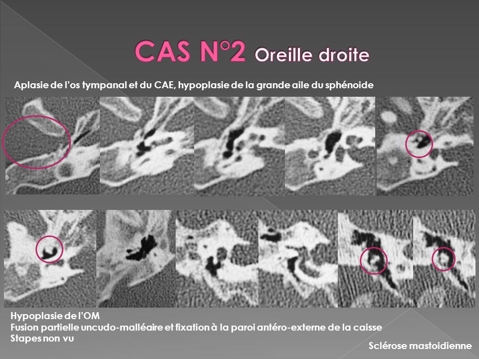 CAS N°2 Oreille droite Aplasie de l’os tympanal et du CAE, hypoplasie de la grande aile du sphénoide.