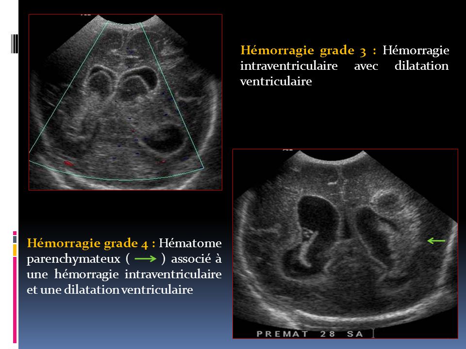 Hémorragie grade 3 : Hémorragie intraventriculaire avec dilatation ventriculaire