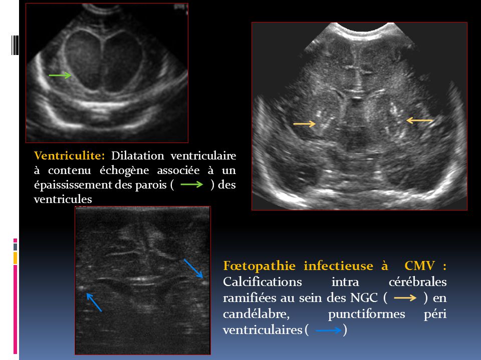 Ventriculite: Dilatation ventriculaire à contenu échogène associée à un épaississement des parois ( ) des ventricules