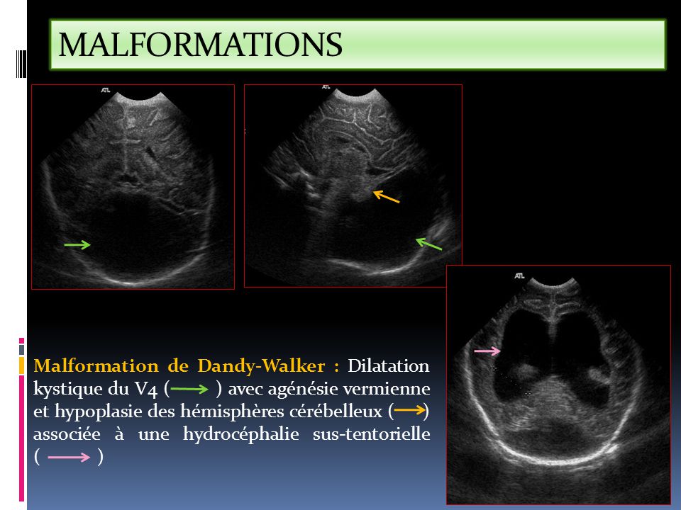 MALFORMATIONS