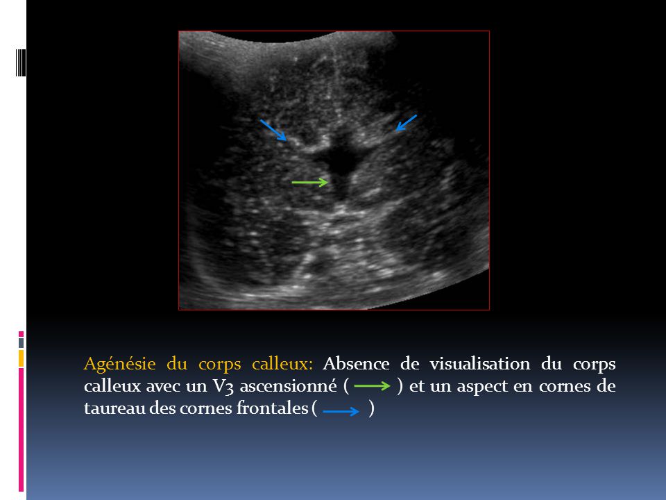 Agénésie du corps calleux: Absence de visualisation du corps calleux avec un V3 ascensionné ( ) et un aspect en cornes de taureau des cornes frontales ( )