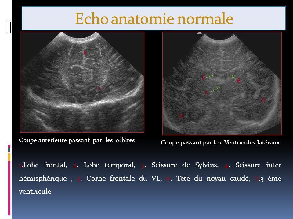 Echo anatomie normale Coupe antérieure passant par les orbites. Coupe passant par les Ventricules latéraux.