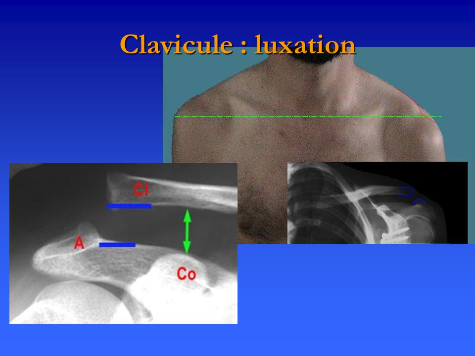 Clavicule : luxation