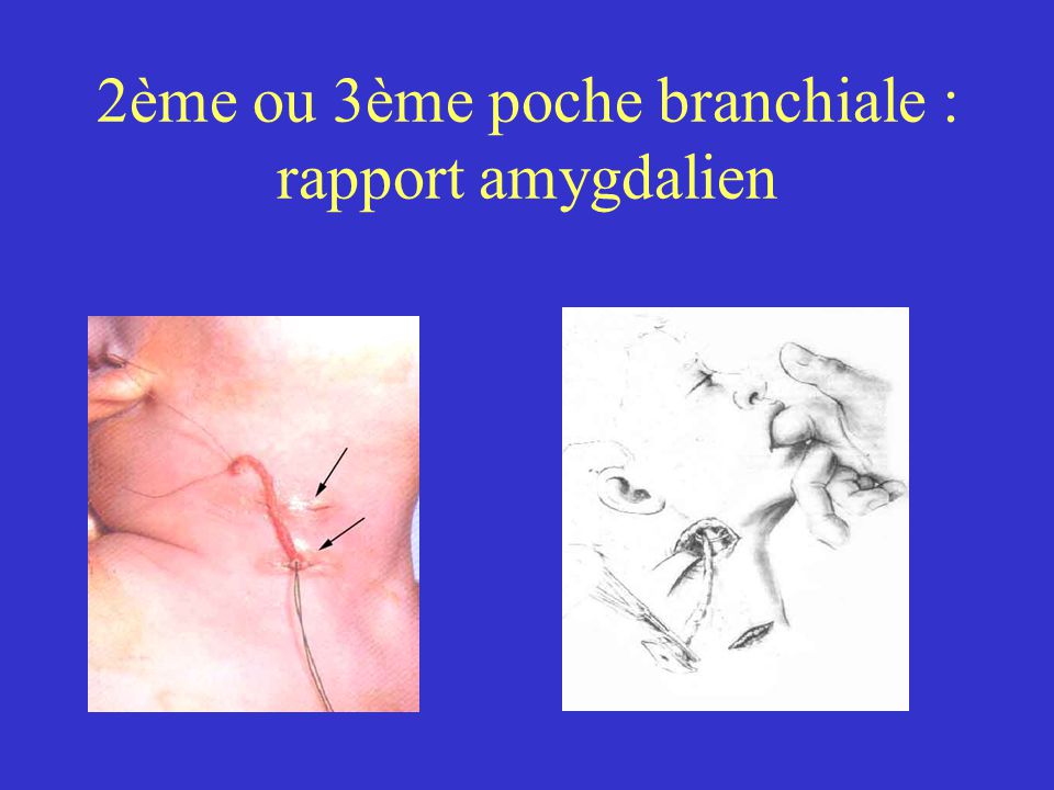 2ème ou 3ème poche branchiale : rapport amygdalien