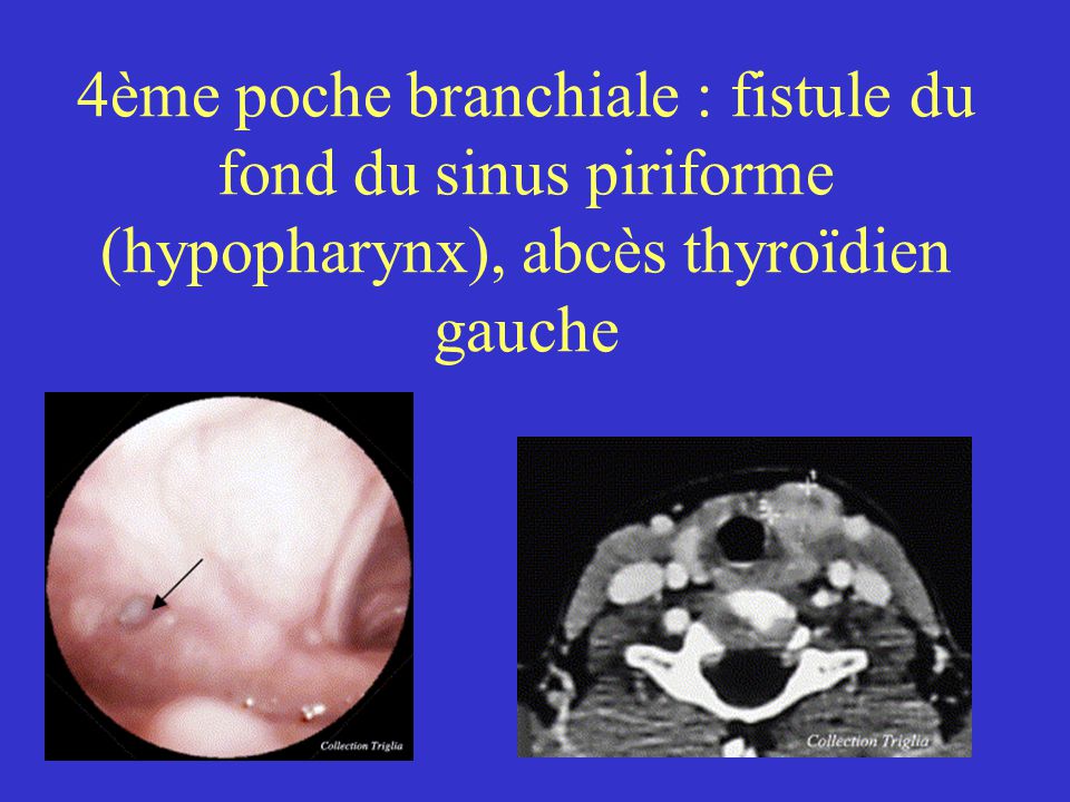 4ème poche branchiale : fistule du fond du sinus piriforme (hypopharynx), abcès thyroïdien gauche