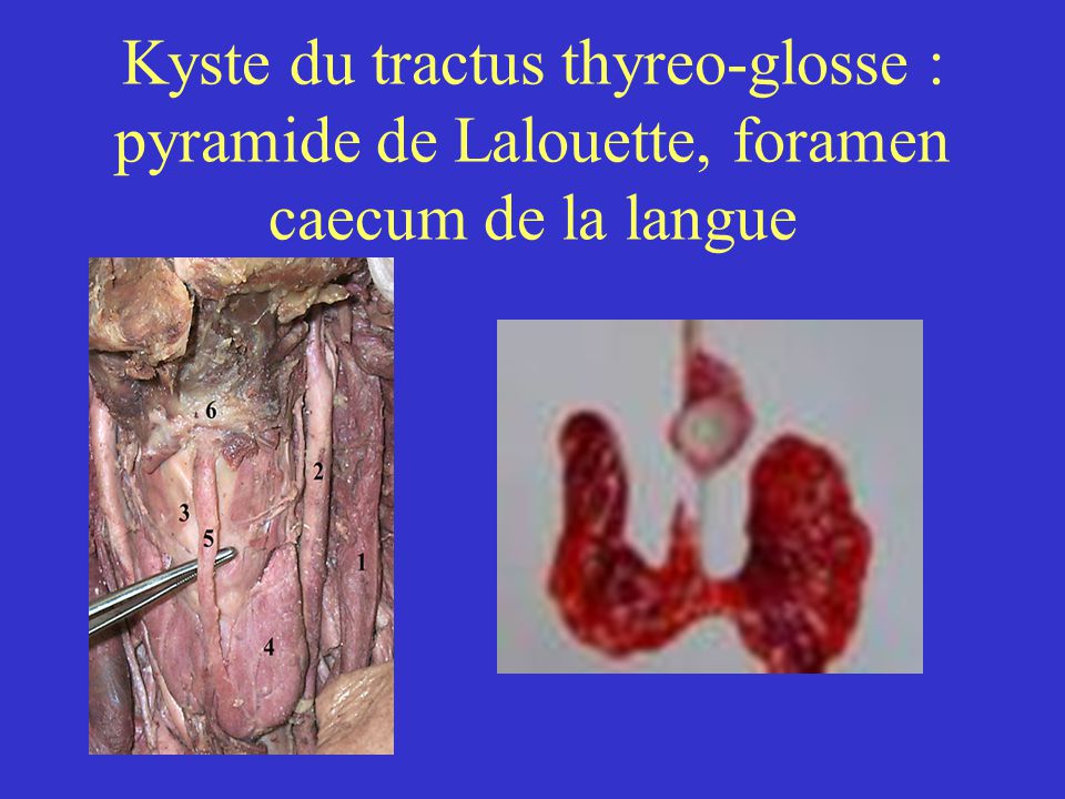 Kyste du tractus thyreo-glosse : pyramide de Lalouette, foramen caecum de la langue