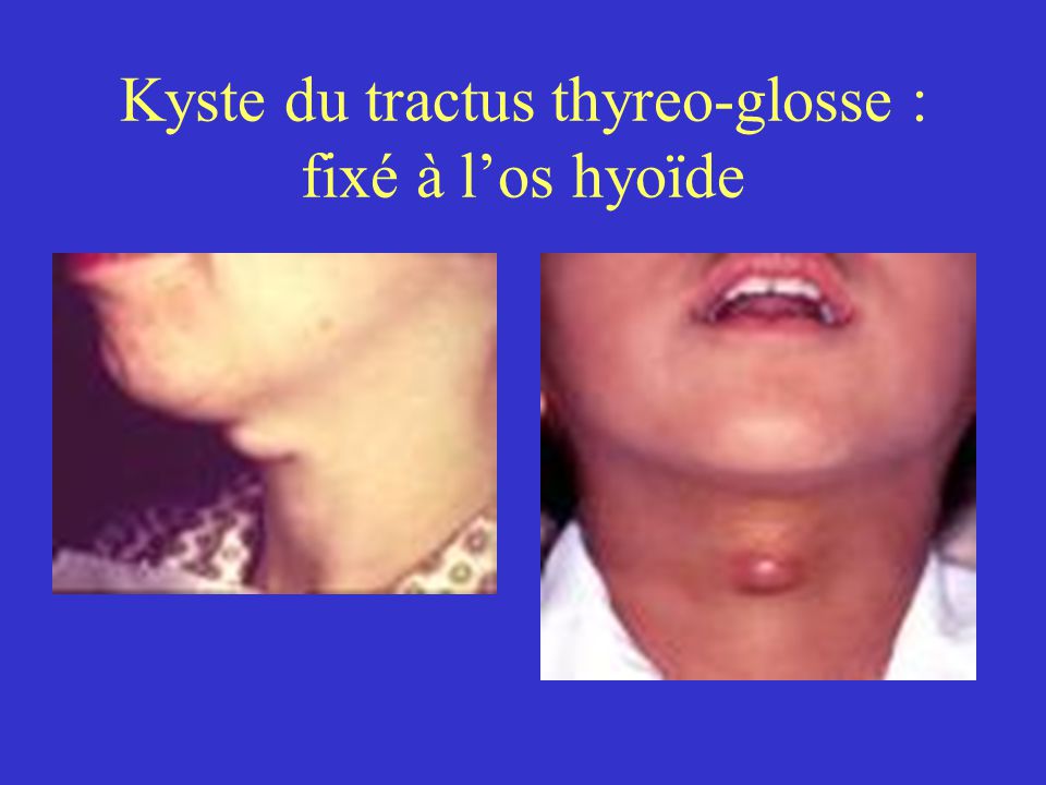 Kyste du tractus thyreo-glosse : fixé à l’os hyoïde
