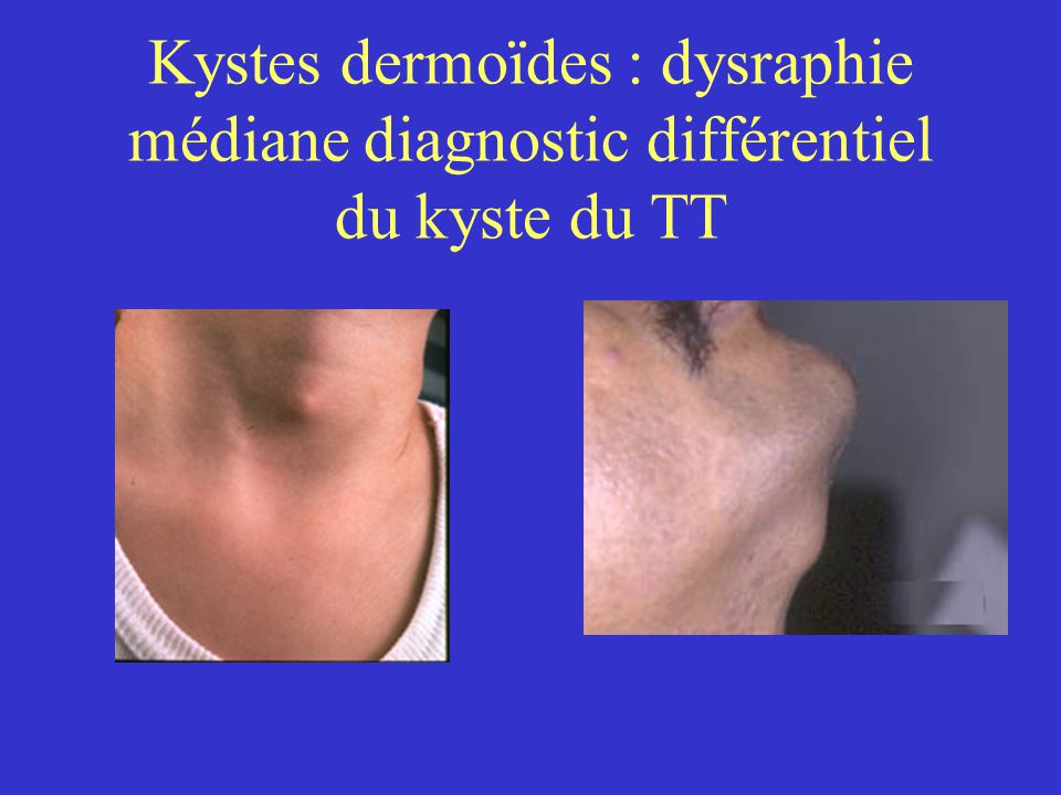 Kystes dermoïdes : dysraphie médiane diagnostic différentiel du kyste du TT