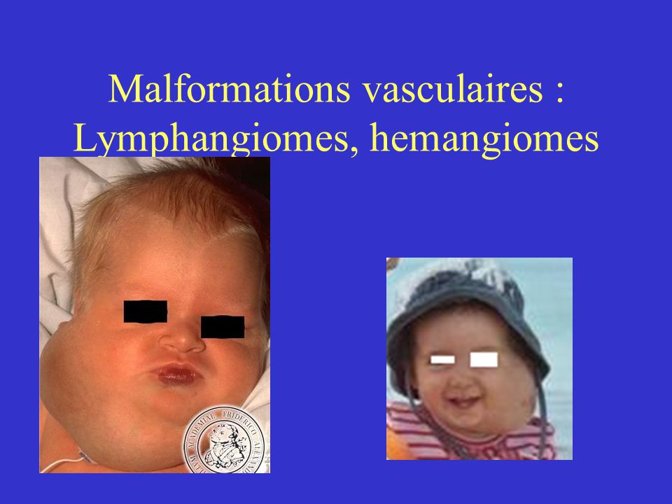 Malformations vasculaires : Lymphangiomes, hemangiomes