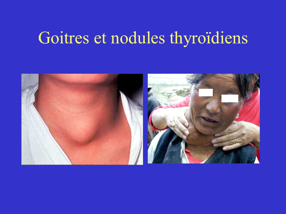 Goitres et nodules thyroïdiens