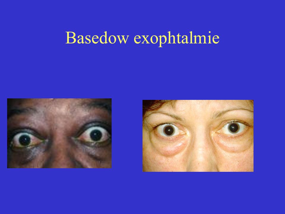 Basedow exophtalmie
