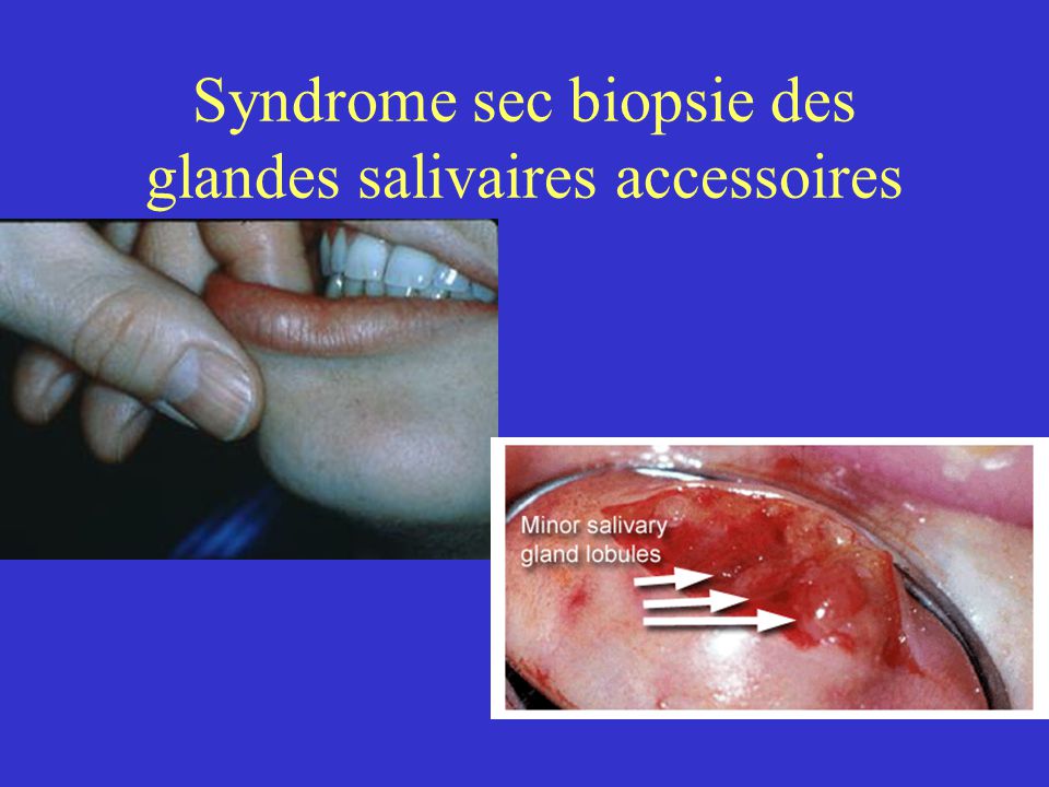 Syndrome sec biopsie des glandes salivaires accessoires
