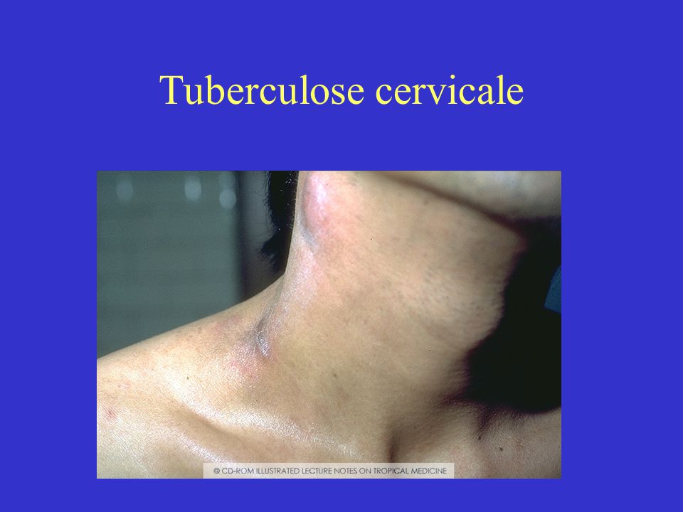 Tuberculose cervicale