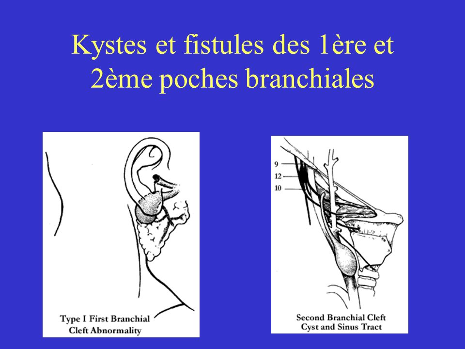 Kystes et fistules des 1ère et 2ème poches branchiales