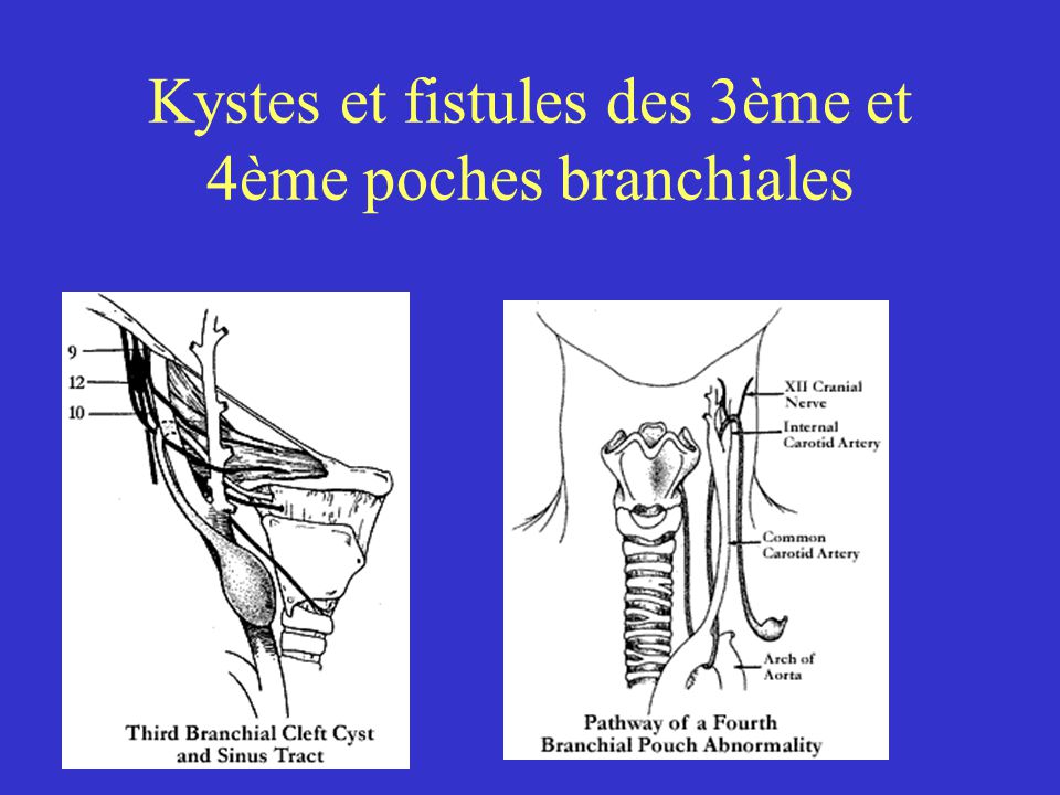 Kystes et fistules des 3ème et 4ème poches branchiales