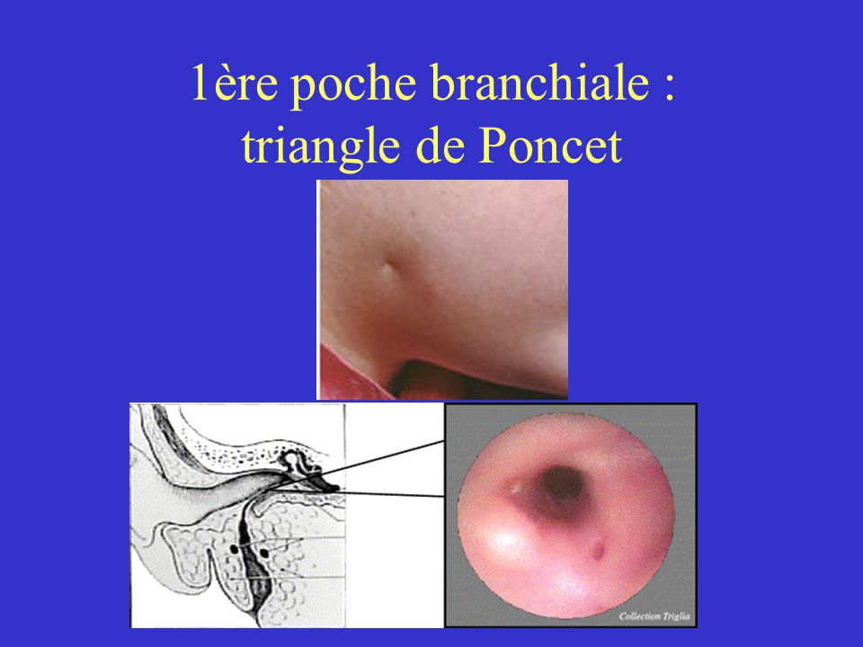1ère poche branchiale : triangle de Poncet