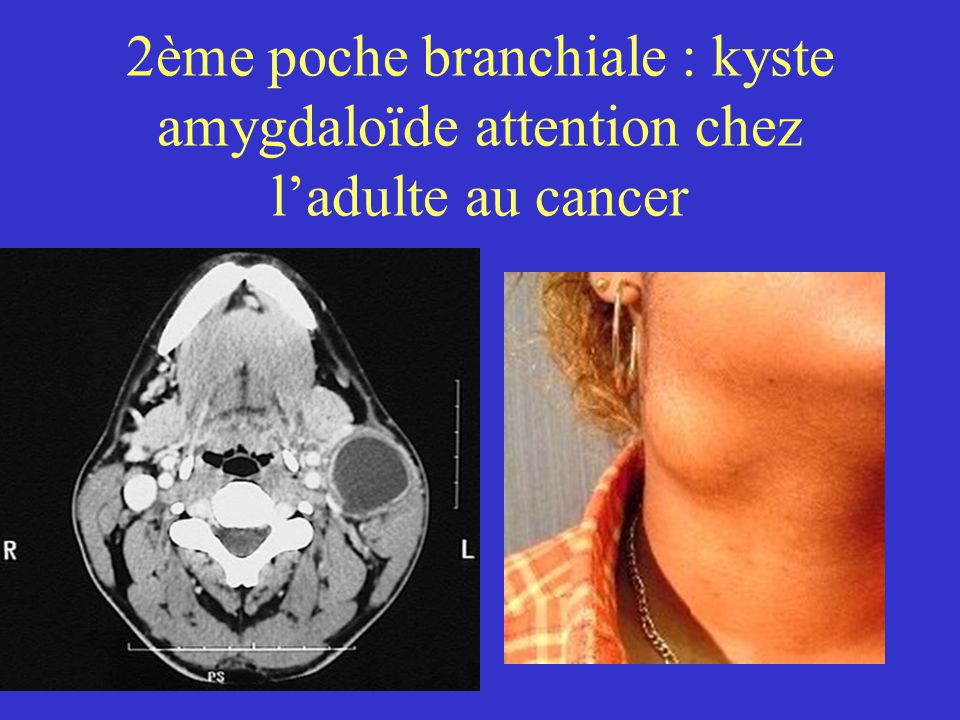 2ème poche branchiale : kyste amygdaloïde attention chez l’adulte au cancer