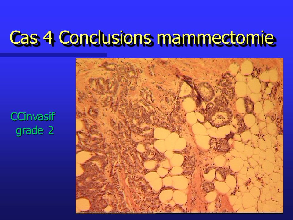 Cas 4 Conclusions mammectomie