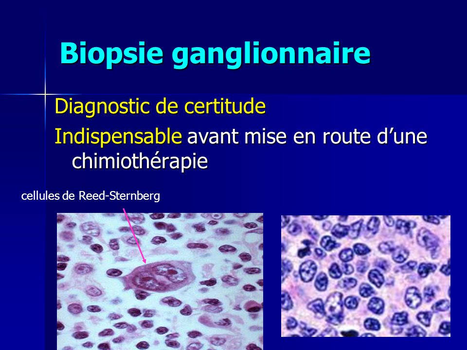 Biopsie ganglionnaire