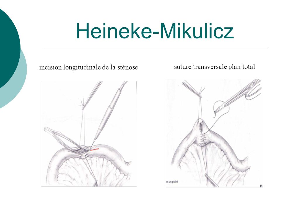 Heineke-Mikulicz suture transversale plan total