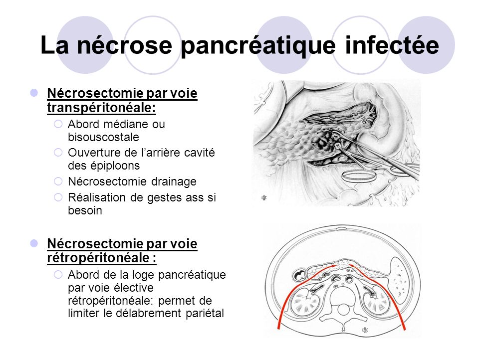 La nécrose pancréatique infectée