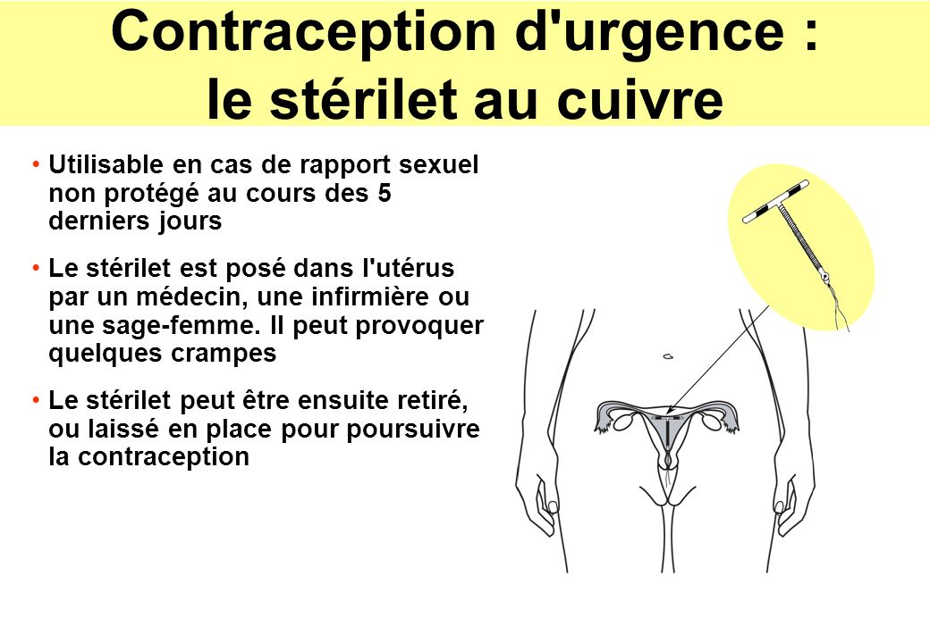 Contraception d urgence : le stérilet au cuivre