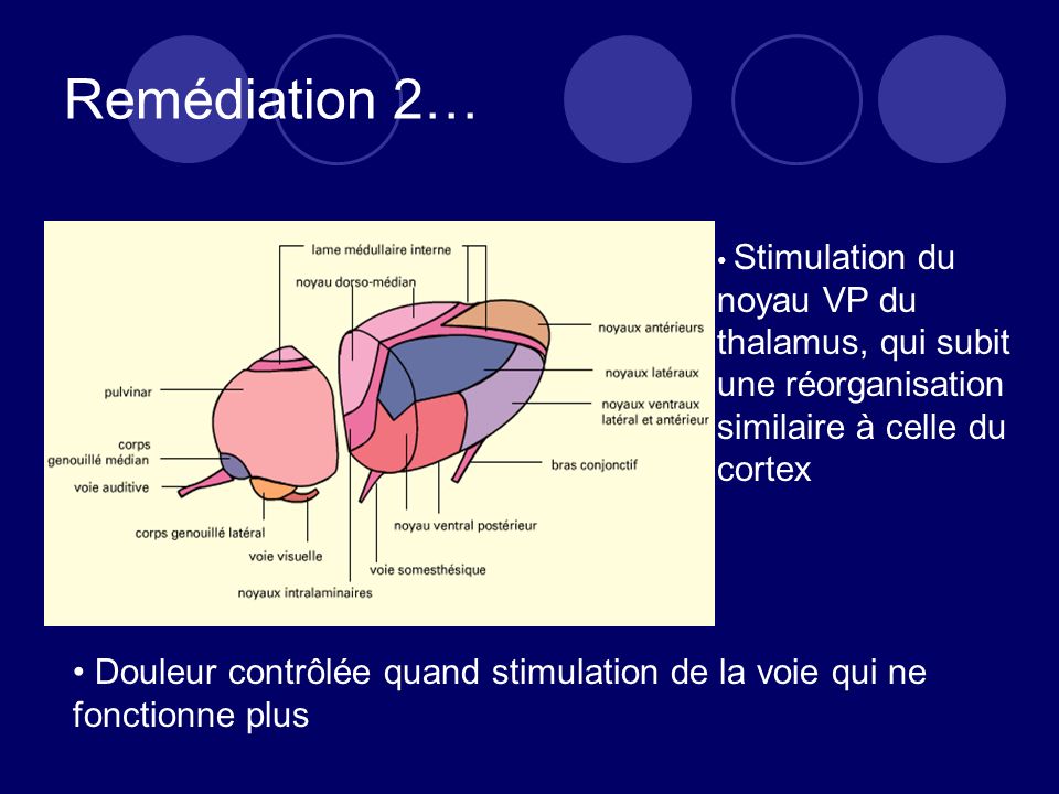Remédiation 2… Stimulation du noyau VP du thalamus, qui subit une réorganisation similaire à celle du cortex.