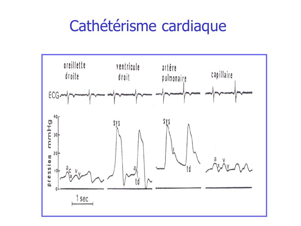 Cathétérisme cardiaque