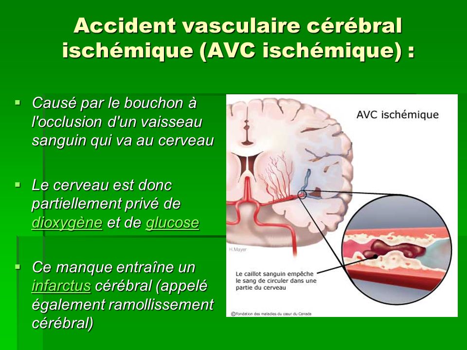 Accident vasculaire cérébral ischémique (AVC ischémique) :