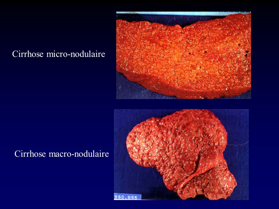 Cirrhose micro-nodulaire