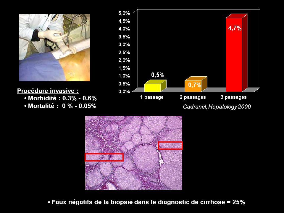 • Faux négatifs de la biopsie dans le diagnostic de cirrhose = 25%
