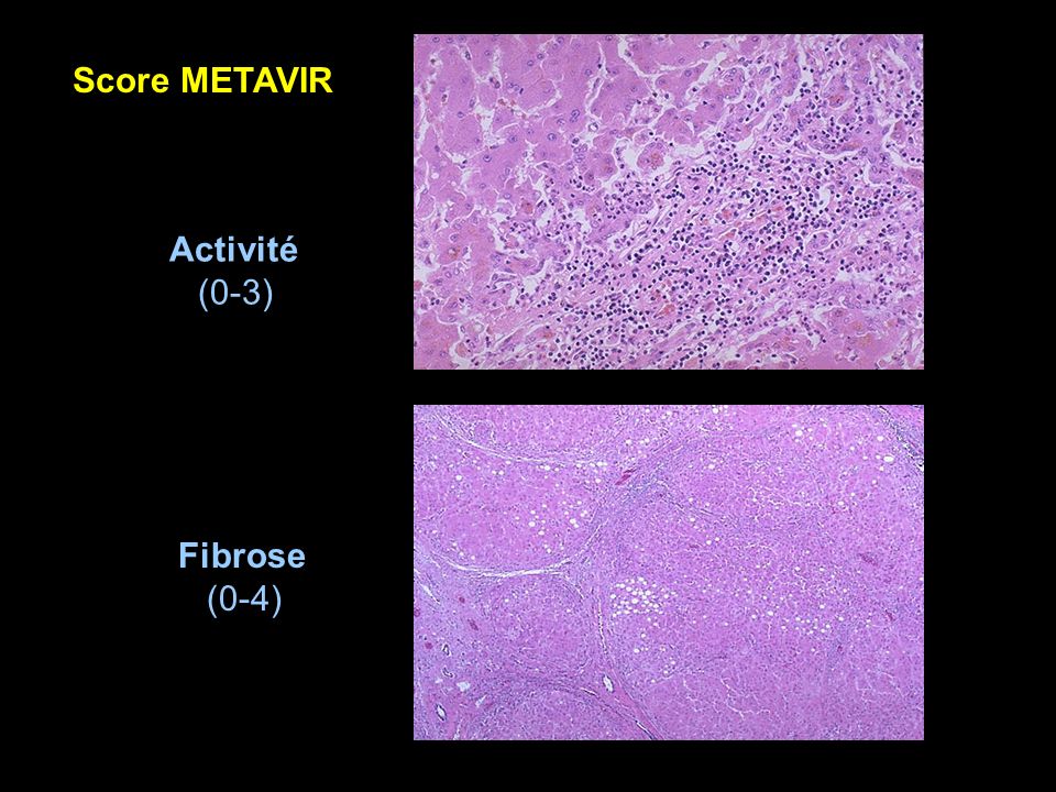 Score METAVIR Activité (0-3) Fibrose (0-4)