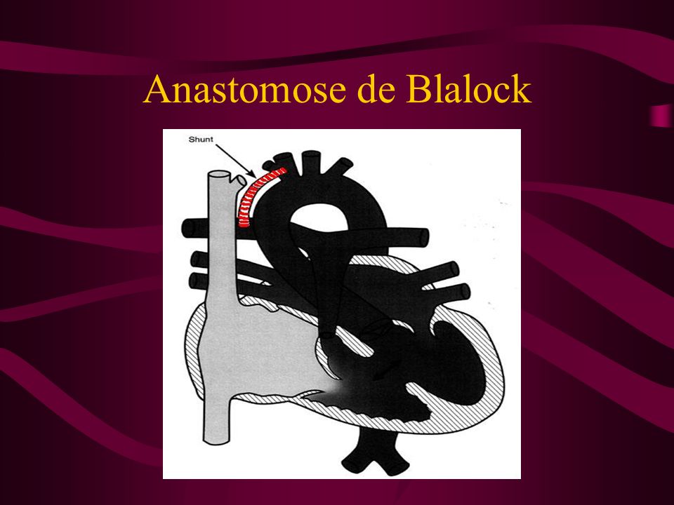 Anastomose de Blalock