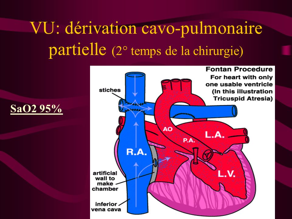 VU: dérivation cavo-pulmonaire partielle (2° temps de la chirurgie)