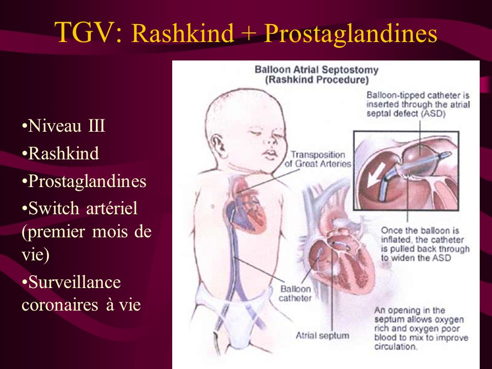 TGV: Rashkind + Prostaglandines