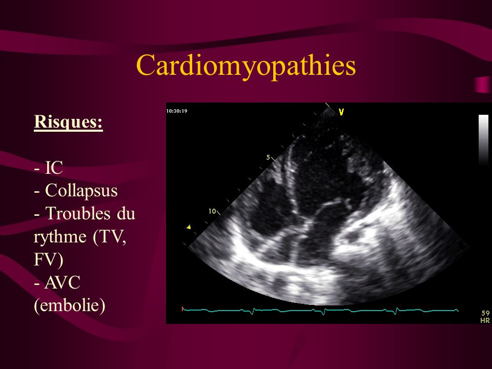 Cardiomyopathies Risques: IC Collapsus Troubles du rythme (TV, FV)